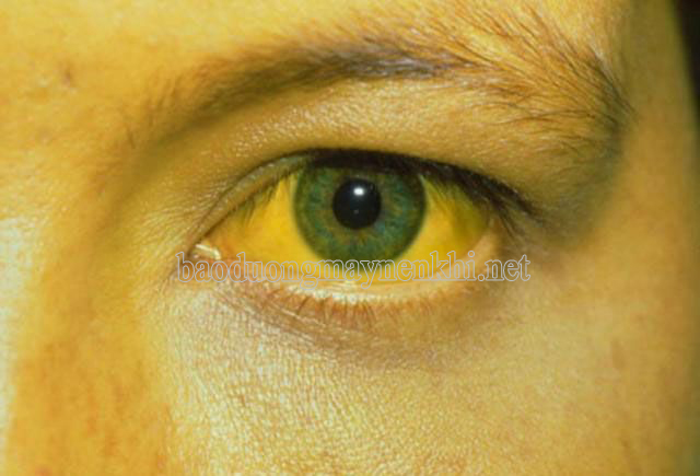 Khi xuất hiện vàng mắt, vàng da, cần xét nghiệm hàm lượng Albumin